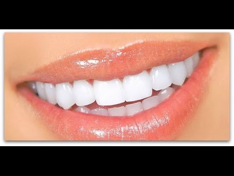 best home teeth whitening kit reddit